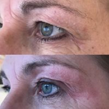 Plasma Pen before and after treatment